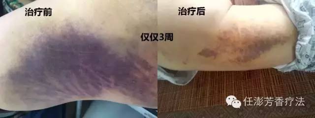 【芳香疗法 ｜ 富有挑战性的经典案例】“三周”缓解车祸导致的瘀伤