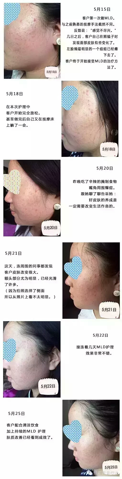 【芳香疗法 ｜ 案例分享】手动淋巴引流（MLD）成功减轻面部痘痘小案例~ 第 1 张