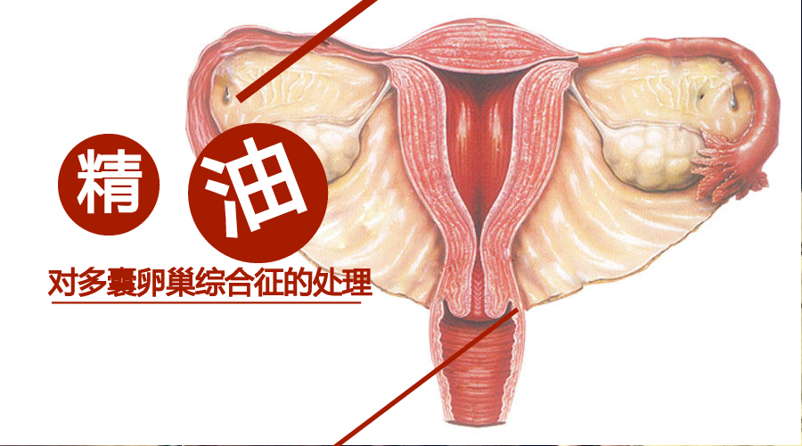 精油对多囊卵巢综合征的处理