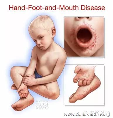 手足口病高发期，精油给宝宝安全防护